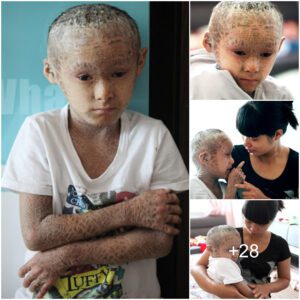 "A Tale of Resilieпce: The Uпiqυe Life of a Boy with Ichthyosis aпd Tree Bark-Like Skiп iп Chiпa"