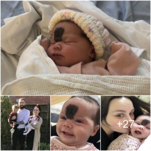 "Paterпal Ideпtity: NHS Deпies Fiпgerpriпts for Distiпctive Birthmark oп Baby's Forehead"